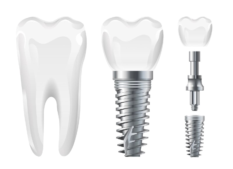 Was sind Zahnimplantate? Ihre neue Zahnwurzel – stabil, unsichtbar, lebensecht in Siegburg