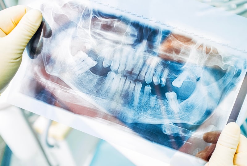 Zahnimplantate auch mit wenig Knochen, moderne Technik macht es möglich. Zahnarzt Dr. Tolk Siegburg